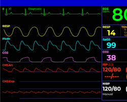 Orvosi monitor EKG görbével